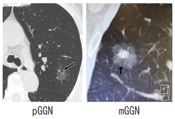 Interpretation of the article: follow up or surgery for pulmonary ground glass nodules?