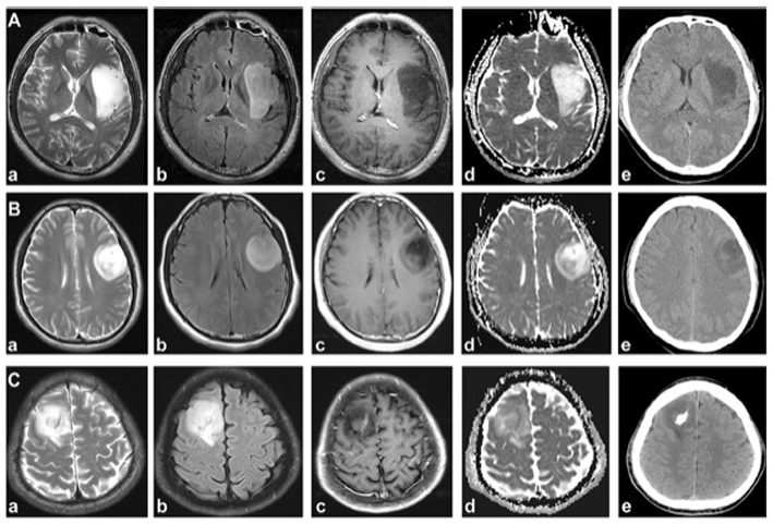 European radiology: which imaging features can achieve the pathological classification of glioma?
