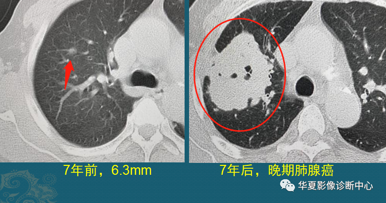 Can ground glass pulmonary nodules become lung cancer? Show you four outcomes of follow-up