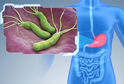 Top issue article: eradication of Helicobacter pylori can reduce the risk of gastric cancer by 50%!