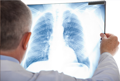 Is my multiple pulmonary nodules malignant?